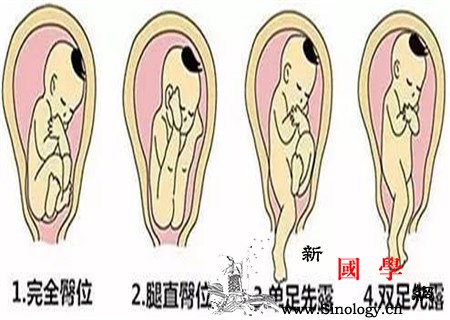 胎儿头位和臀位的区别这几点教你区分_胎位-头先-教你-几点-
