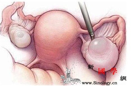 人工受孕是什么意思人工受孕的注意事项_试管婴儿-子宫颈-受精-受孕-不孕不育