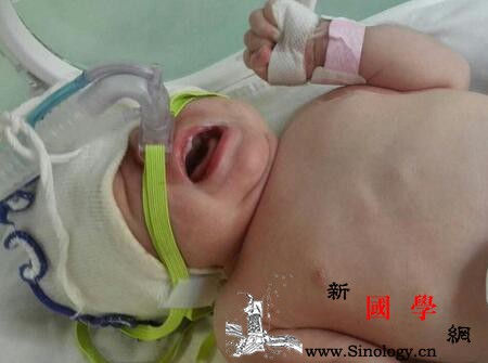 新生儿呼吸机的作用_适应症-适用于-换气-通气-