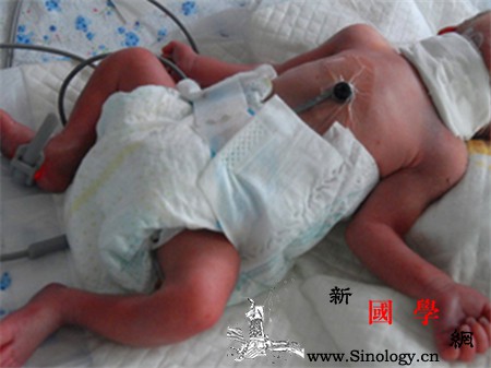 新生儿发绀原因是什么_肺动脉-青紫-杂音-血流-