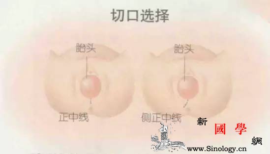生孩子你被侧切了吗？其实你可以不挨这一刀_缝针-会阴-分娩-撕裂-