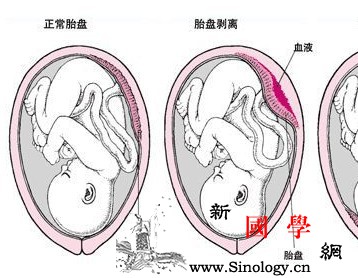 什么是前置胎盘以及它的种类_完全性-子宫颈-胎盘-妊娠-