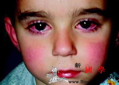 儿童川崎病传染吗？_复合物-机理-增高-传染-