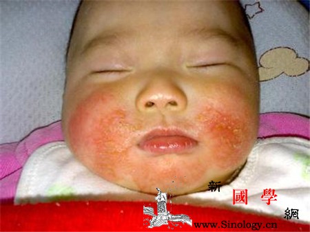 新生儿湿疹治疗的注意事项_湿疹-喂养-用药-选用- ()