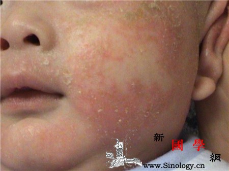 宝宝湿疹结痂了是不是快好了_结痂-湿疹-刺激-食物-