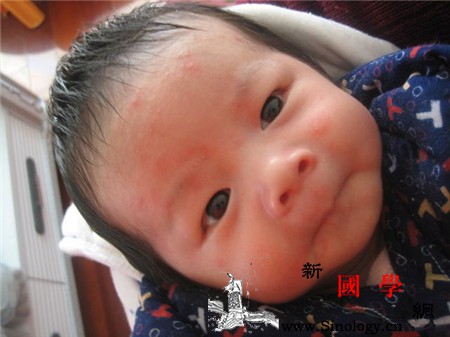 新生儿脸上有小红点带白头是什么原因_白头-湿疹-药物-脸上-