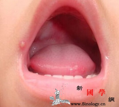 手足口病疱疹怎么治疗怎么根到病除不结疤？_皮疹-手足-臀部-疱疹-