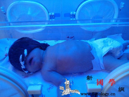 新生儿照蓝光受罪吗_光疗-胆红素-黄疸-受罪-