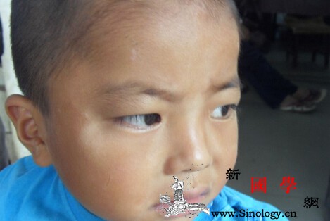 儿童白色糠疹是什么原因导致的宝宝日常容易忽_蛔虫-日光-白色-导致-