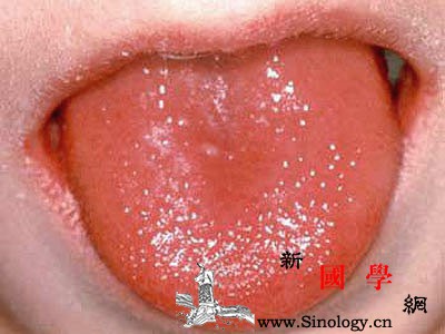 孩子草莓舌会有什么病？_猩红热-病原菌-会有-舌苔-