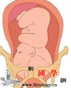 顺产过程中宝宝是怎么爬出产道的？_产道-骨盆-分娩-旋转-
