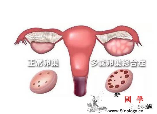 多囊卵巢究竟是怎么影响怀孕的？又该怎么好孕呢_卵泡-排卵-卵巢-综合症-怀孕准备