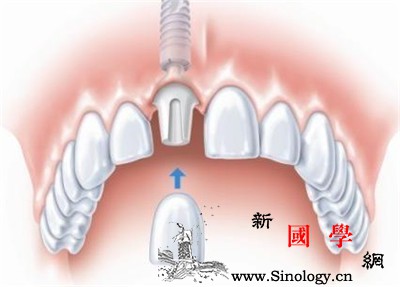 儿童龋齿充填怎么进行？_乳牙-龋齿-充填-适用于-