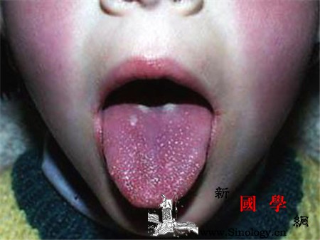 高烧不退合并草莓舌?川崎氏症警讯_皮疹-冠状动脉-超音波-草莓-