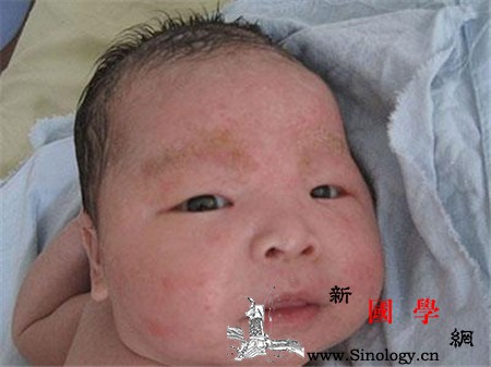 宝宝缺钙会引起湿疹吗_湿疹-出汗-衣物-症状-