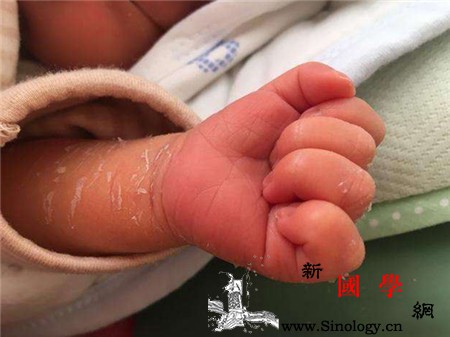 新生儿手脚脱皮是怎么回事_脱皮-分泌物-脱落-手脚-