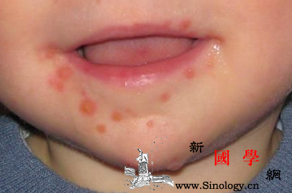 猩红热皮疹几天消退_猩红热-皮疹-青霉素-几天-
