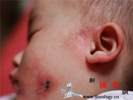 新生儿耳朵流黄水怎么回事_耵聍-外耳道-湿疹-怎么回事-