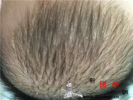 宝宝头垢怎么形成的_囟门-结痂-头上-洗头-