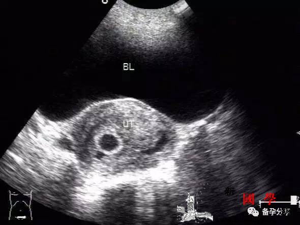 B超单能看出孩子是男孩还是女孩?真的假的?_股骨-超图-宝宝-圆圆-生男生女