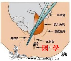 生宝宝前为什么要剃下面的毛？有什么好处吗？_感染率-阴毛-会阴-产妇-