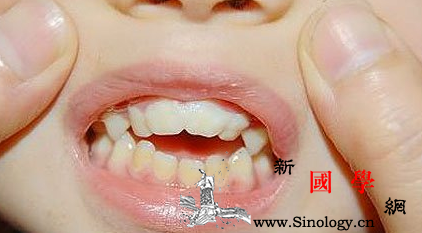 乳牙不掉是什么原因_恒牙-乳牙-龋齿-滞留-