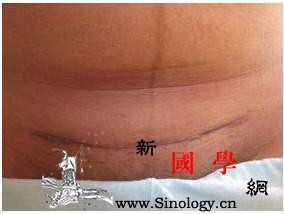 剖宫产后疤痕修复_刺痒-肉皮-表皮-疤痕-