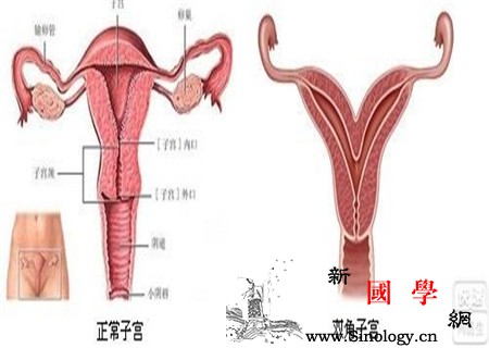 双子宫纵隔是什么意思记得与双子宫区分_纵隔-宫颈-妊娠-畸形-