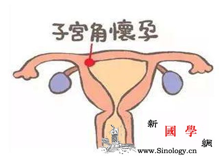 宫角妊娠是什么意思宫角妊娠知识大讲解_腹痛-伴有-妊娠-阴道-