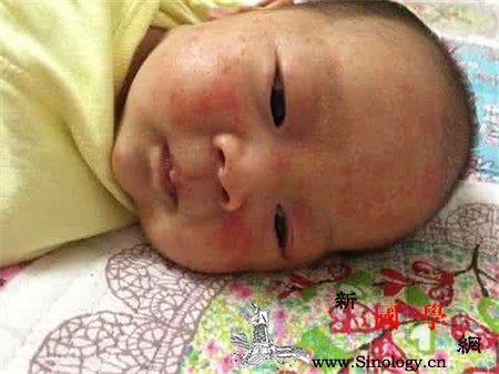 新生儿奶癣怎么引起的又要怎么护理呢_哺乳期-刺激性-湿疹-患儿-