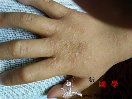 手背上起小疙瘩很痒_水疱-止痒-溶液-黄柏-