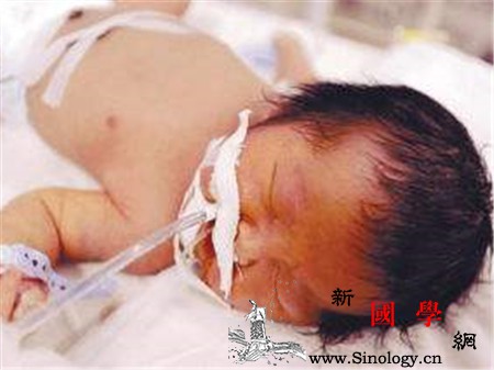 新生儿abo溶血严重吗可以预防吗_胆红素-溶血-黄疸-机体-