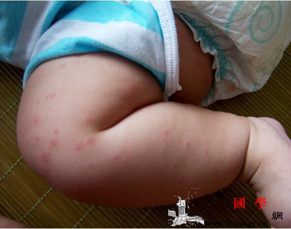 儿童秋季荨麻疹的影响有哪些_相关文章-水肿-荨麻疹-秋季-