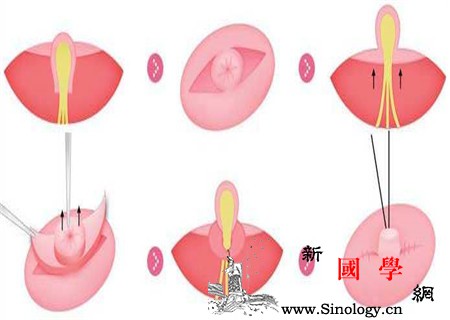 乳头内陷图片对比教你一秒分辨_用手-教你-乳头-炎症-