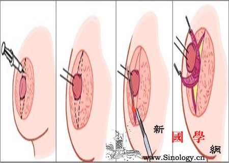 乳头凹陷能致癌吗致癌常识要知晓_牵拉-致癌物-乳汁-凹陷-