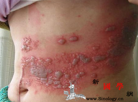 带状疱疹传不传染_麻醉性-吗啡-毁损-阻滞-