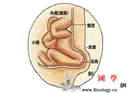 孕妇疝气的症状图片特有表现让你早明确_疝气-腹股沟-肿块-排便-