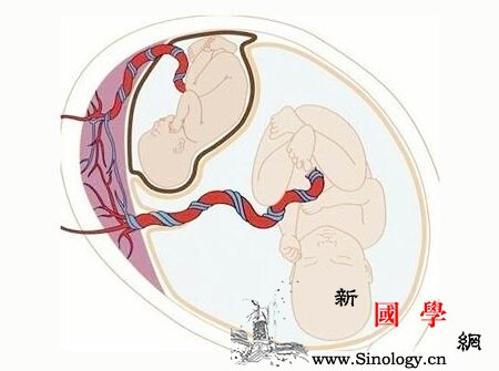 寄生胎是怎么形成的_胎发-足月-男婴-胎儿-