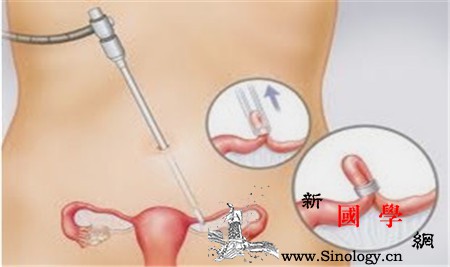 上环能避孕吗_上环-前列腺素-目的-宫内-
