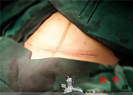 剖腹产伤口纱布几天可以拿掉纱布去除时间别太_拆线-几天-剖腹产-纱布-生男生女