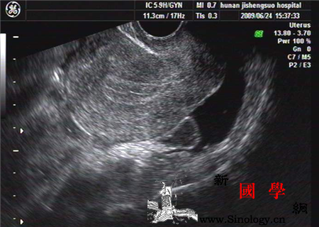 处女怎么做阴超处女一定要看！_宫外孕-囊肿-卵巢-怎么做-孕前检查