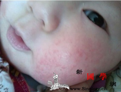 儿童脸红起红疹是怎么回事_药膏-脸红-皮肤过敏-刺激-