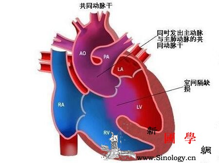 早产儿动脉导管未闭的症状_肺动脉-早产儿-舒张-导管-