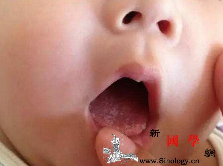 新生儿胆道闭锁护理措施_洗肠-胆道-闭锁-肠道-