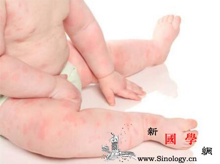 新生儿单纯疱疹病毒感染症状_抗体-肺炎-病变-表现为-