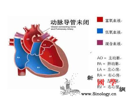 早产儿动脉导管未闭是怎么回事_血循环-肺动脉-主动脉-早产儿-