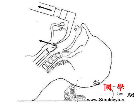 新生儿乳汁吸入性肺炎怎么办_鼻饲-预后-乳汁-吸入-