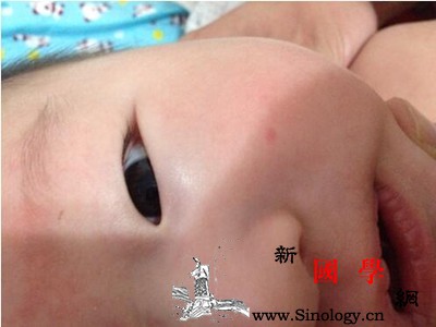 孩子嘴巴里面起小红点怎么回事_水疱-黏膜-怎么回事-疱疹-