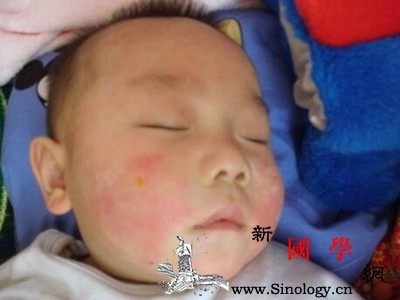 孩子嘴巴周围起红疹怎么回事_皮疹-怎么回事-擦拭-症状-