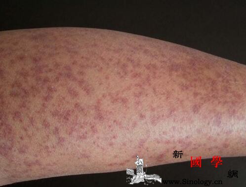 过敏性紫癜血管炎怎么治疗_强的松-组胺-紫癜-剂量-